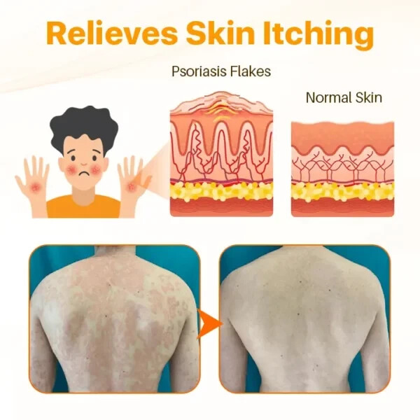 1 Pack Crema Para Dermatitis Eczema Psoriasis Para Comezon Picazon Ronchas En La