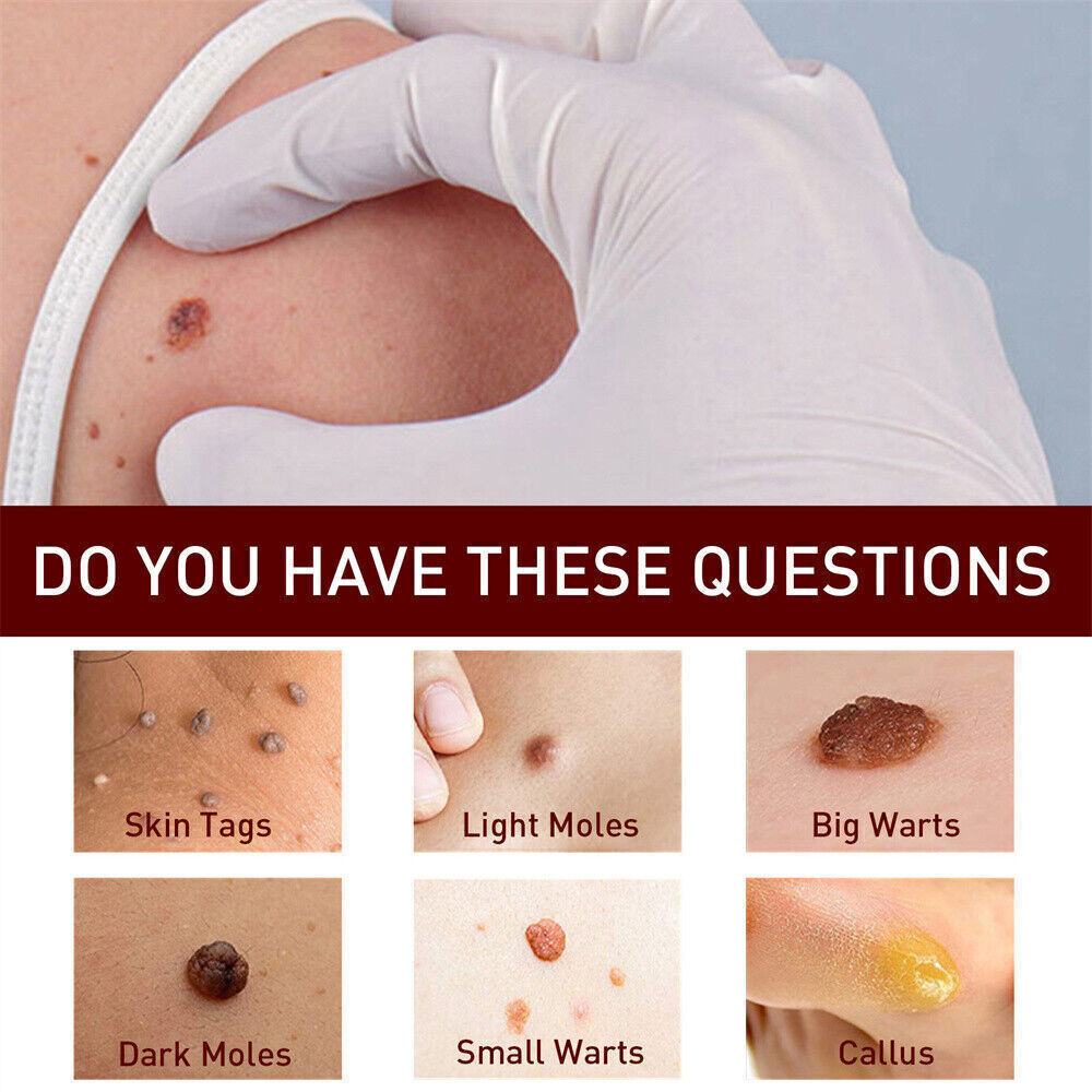“FINAL SAL” Skin Tags & Moles Removal Quick Safe Remover Restore Skin 3ml US