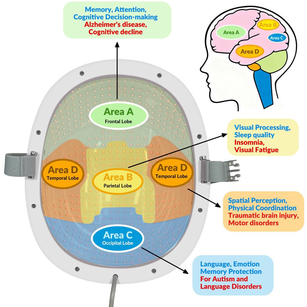 High Power 1070 nm NIR Therapy Helmet for Chronic Migraine Pain and Insomnia