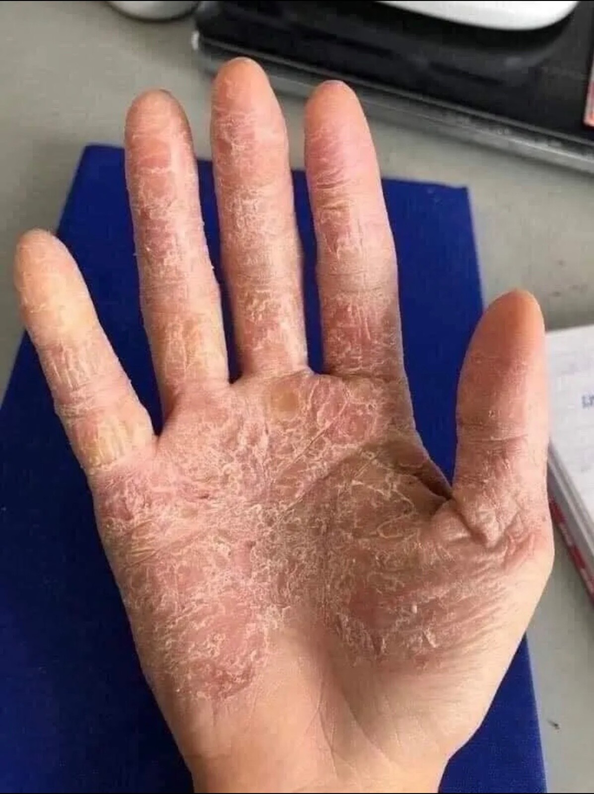 DMD- COMBO OF MEDI SKIN TREATMENT FOR PSORIASIS,ECZEMA.