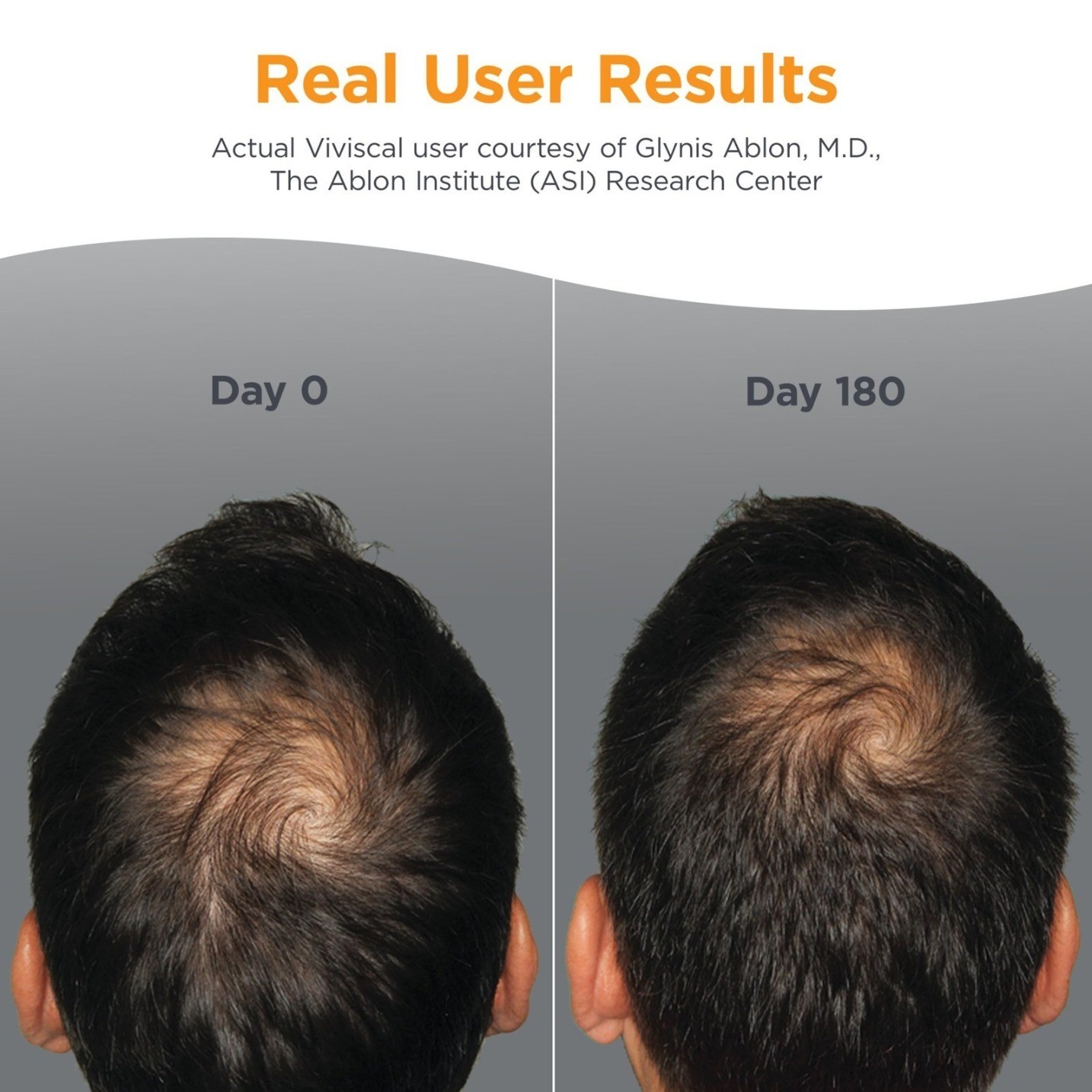 Vivi-scal Men’s Hair Growth Supplements for Thicker Fuller Hair for men