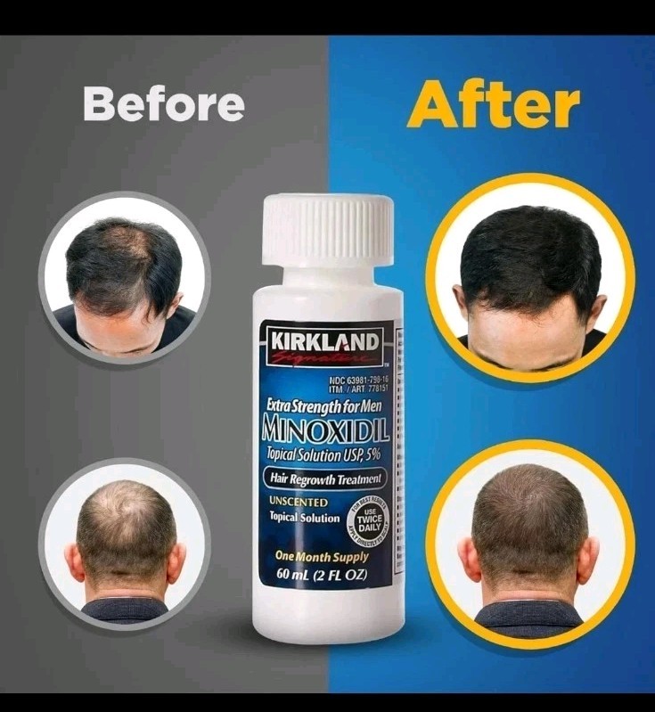 Kirkland Minoxidil 5% Hair Regrowth Treatment 6 Month Supply 6x 2oz NEW SEALED