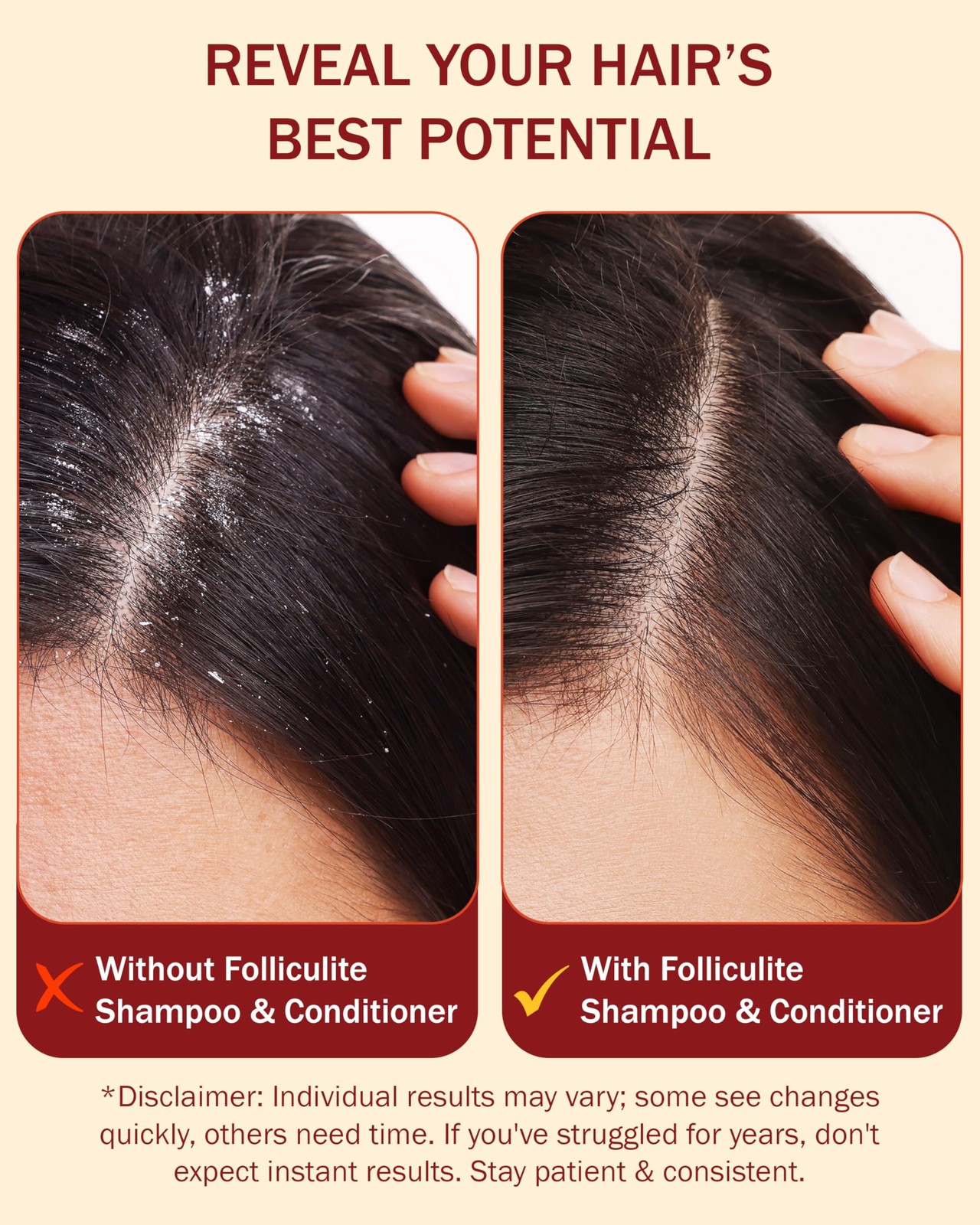 Folliculitis Treatment Shampoo And Conditioner 3 Bha Salicylic Acid Aloe Tea