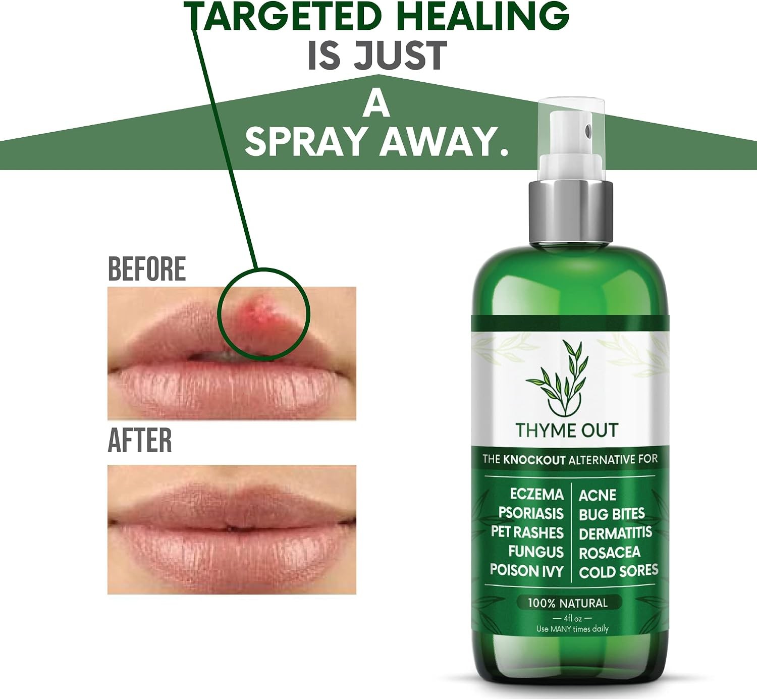 Thyme Out All Natural Eczema Treatment- Psoriasis Treatment – an All-in-One