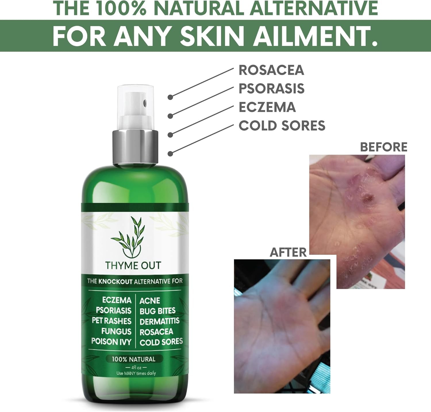 Thyme Out All Natural Eczema Treatment- Psoriasis Treatment – an All-in-One