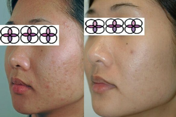 10% Glycolic Acid Night Cream 2oz Excellent for Acne/Aging/Sun Damaged Skin!