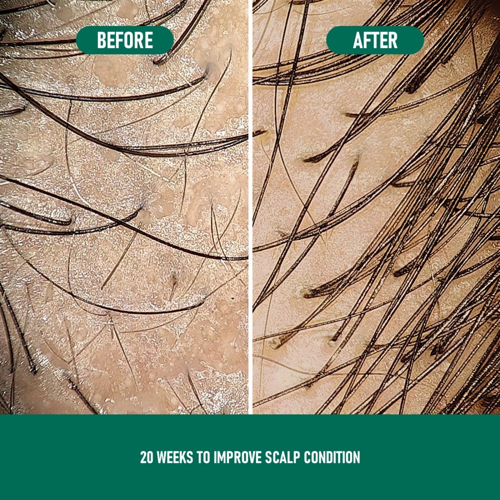 Anti-Hair Loss Mousse Thicker And Fuller Hair