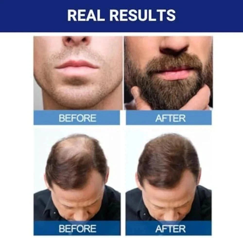 Kirkland Minoxidil 5% Extra Strength Men 6 Month Supply Hair Regrowth FREE SHIP