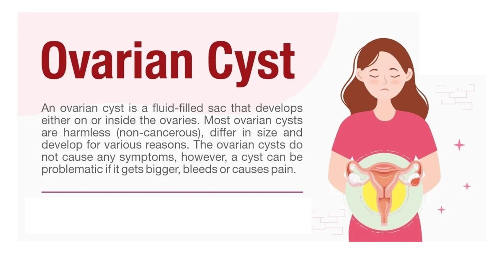 OVARIAN CYST FREE REMOVAL 4 ME – TO TREAT & PREVENT Made in USA – 120 capsules
