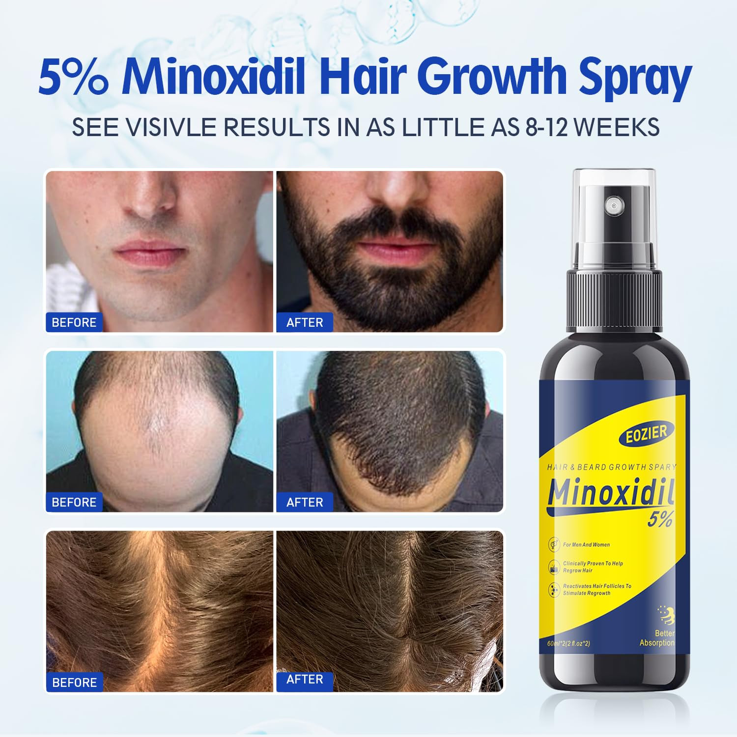 5% Minoxidil with Biotin, Hair Loss Treatments for Women Men Hair Regrowth Treat