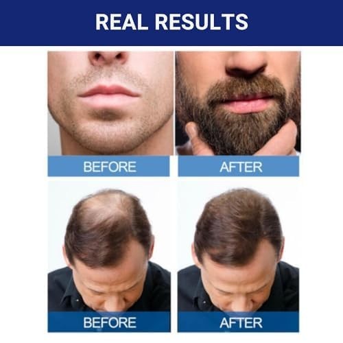 Signature 5% Minoxidil for Men – 2 Ounce Hair Regrowth Solution, 1 Supply