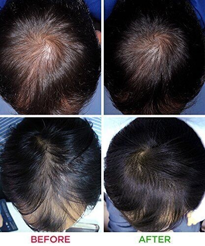 iRESTORE Essential Laser Hair Growth System – Reconditioned – ID-500