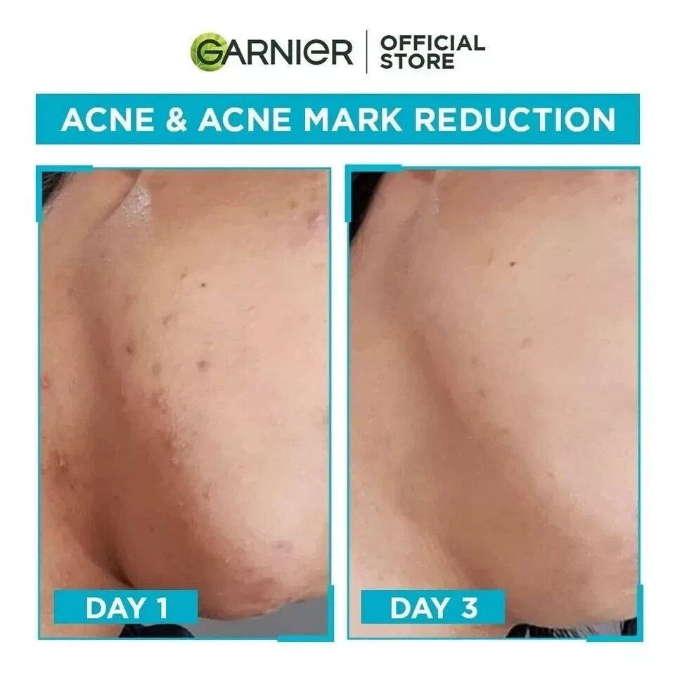 2X Garnier Skin Natural Bright Complete Anti-Acne Booster Serum 30ml