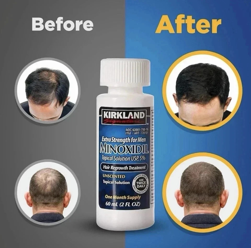 Kirkland Signature Hair Regrowth Treatment Extra Strength for Men, 5% Minoxidil