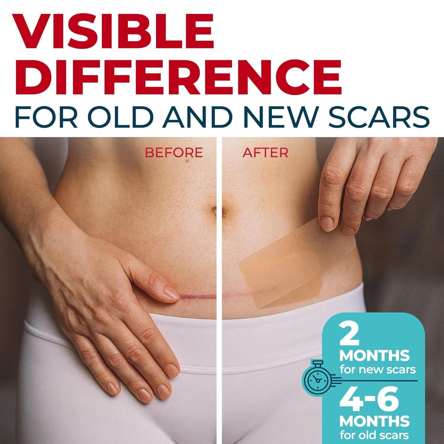 Medical Grade Silicone Scar Tape – 1.6”x150” – Visible Difference on Keloid &…