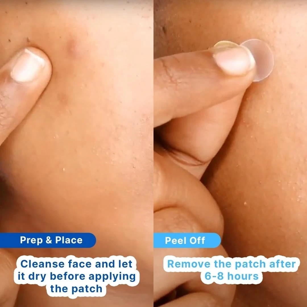 Sotrue Acne Pimple Patches Hydrocolloid For Face Active Acne 36 Waterproof Dots