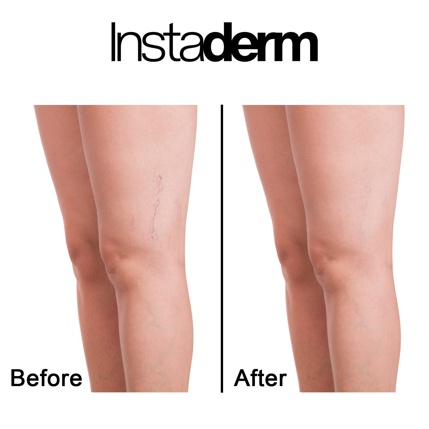 Vitamin K Cream-For Bruising, Spider Veins, Broken Capillaries, & Dark Circles.