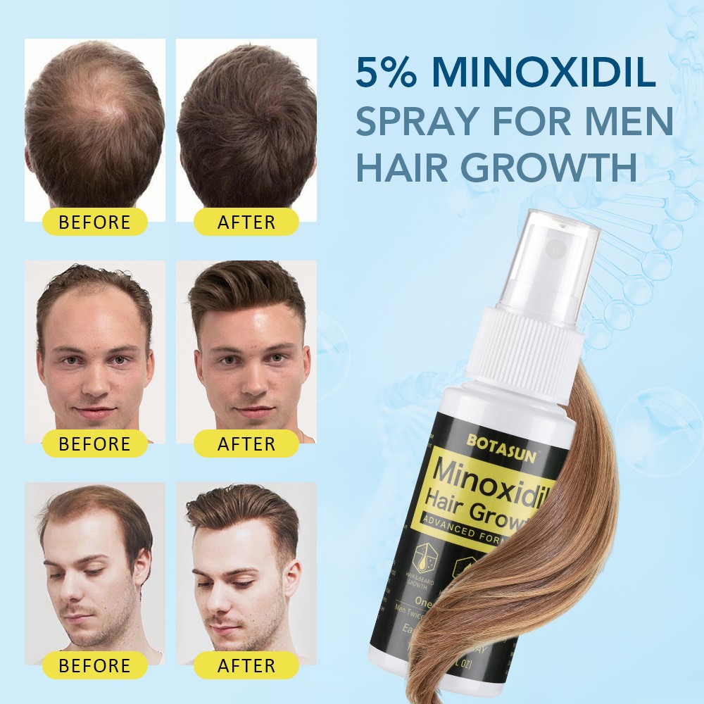Minoxidil 5% Hair Regrowth Treatment Topical Solution for Men 2-10 Month Supply