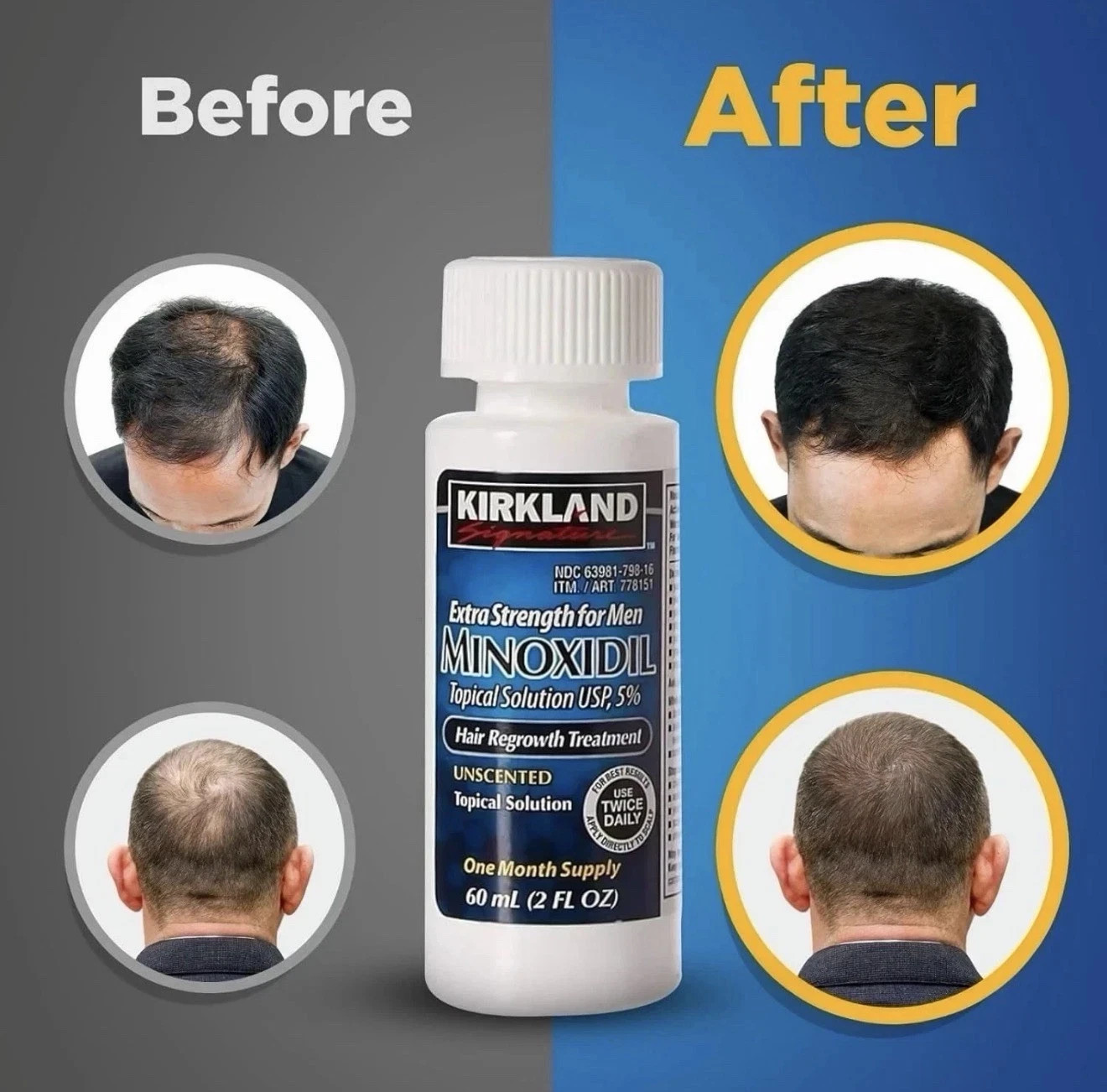Kirkland Signature Minoxidil 5% Hair Regrowth Treatment for Men – 12oz (6x2fl…