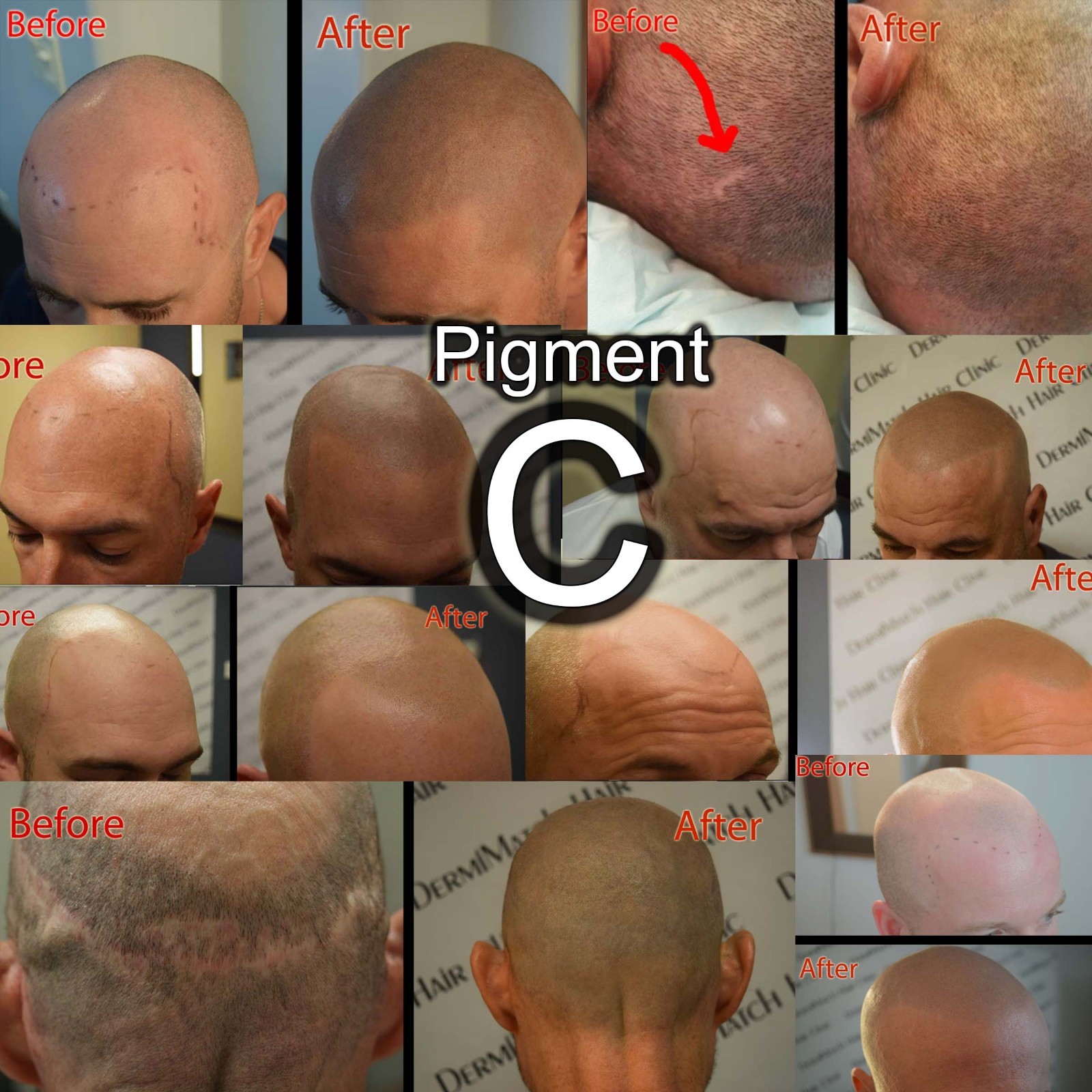Pigment HD-C – Scalp Micropigmentation Pigment by DermMicro (0.5 oz)