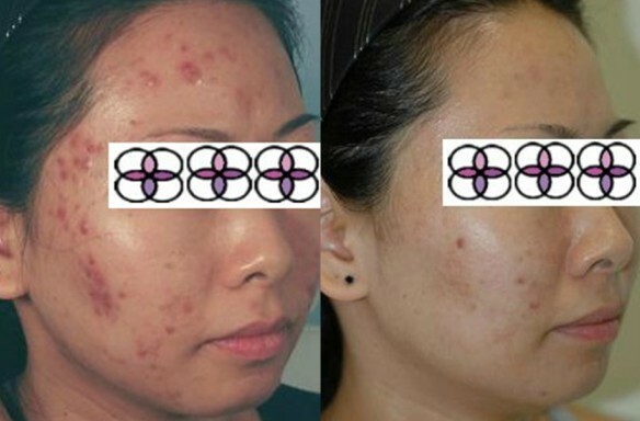 10% Glycolic Acid Night Cream 2oz Excellent for Acne/Aging/Sun Damaged Skin!