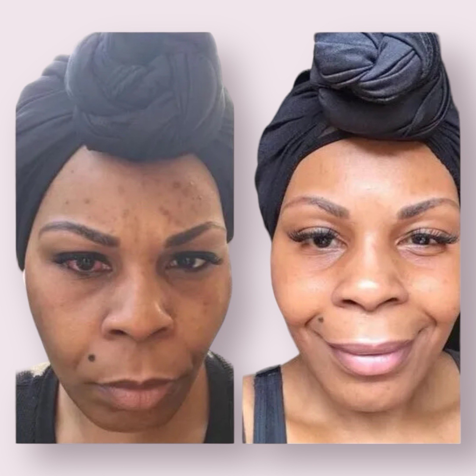Natural Tumeric Soap Dark Spots,Skin Brightening, Scar Fading Lightening Pigment