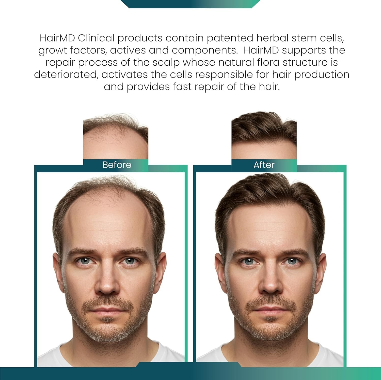 HairMD Post-Transplant Hair Set – 3 Month Kit with Shampoo, Serums & Vitamins