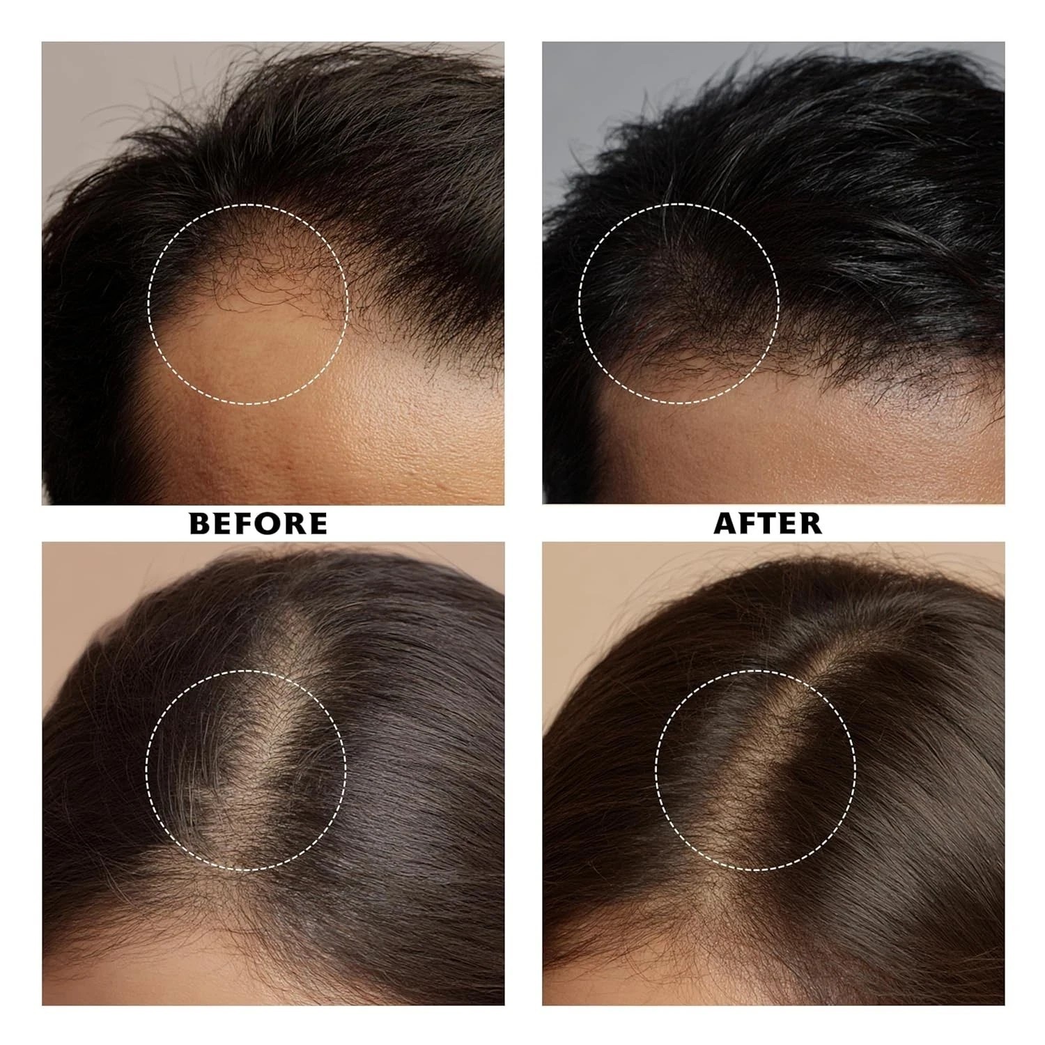 2x Proskire Intense Hair Growth Serum with Redensyl ,30ml each (Pack of 2)