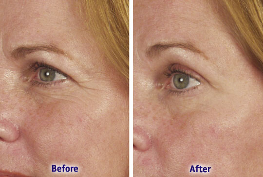 Argireline Matrixyl 3000 Hyaluronic Acid Peptide Serum Wrinkle Collagen Cream
