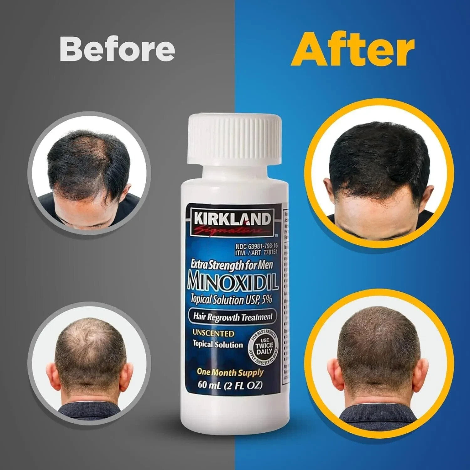 36 MONTHS SUPPLY KIRKLAND GENERIC MINOXIDIL 5% MENS HAIR LOSS REGROWTH TREATMENT