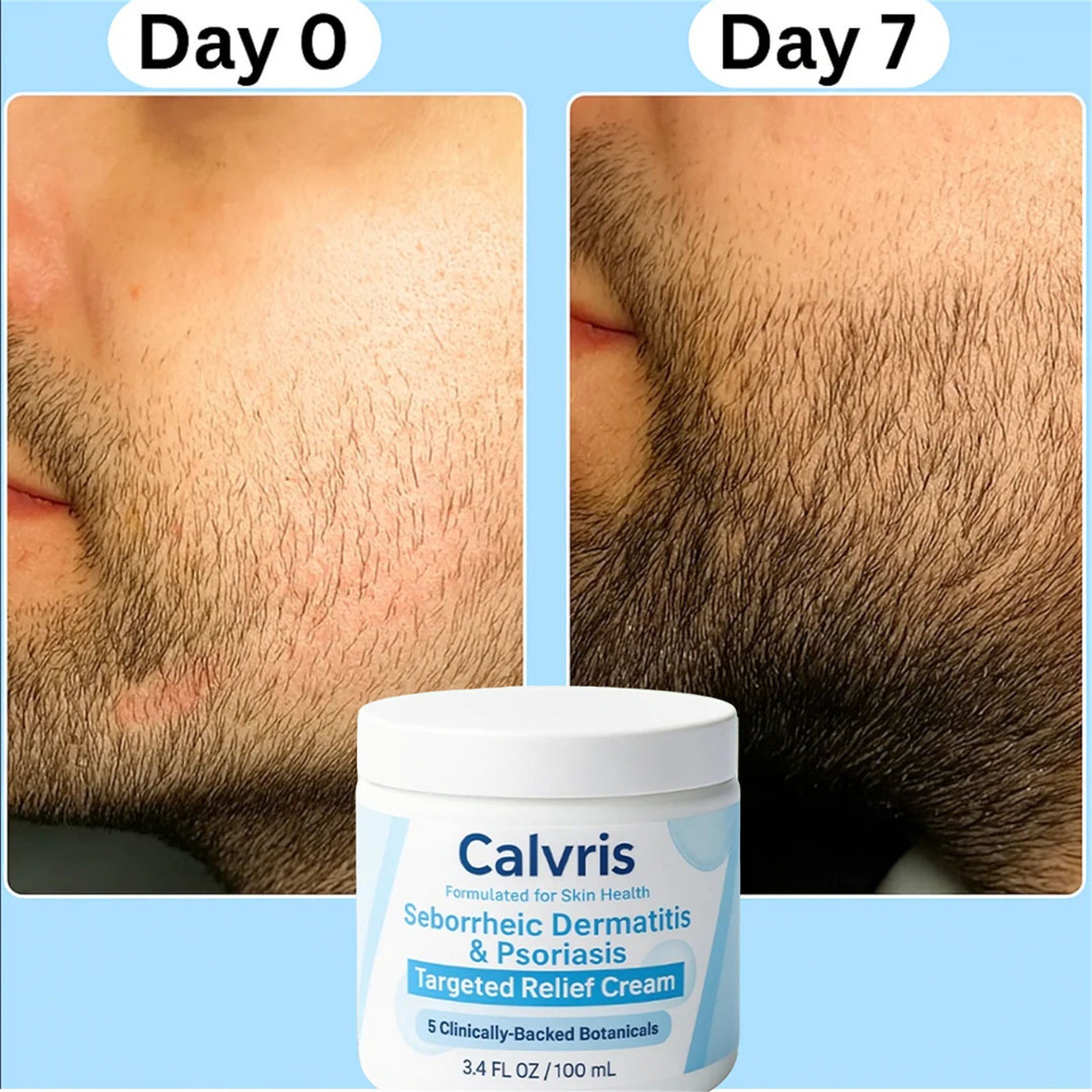 Calvris Seborrheic Dermatitis & Psoriasis Treatment Cream Beard Recovery Cream