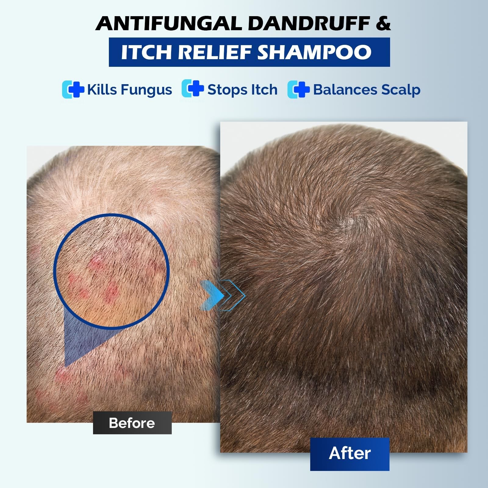 Antifungal Shampoo for Psoriasis, Seborrheic Dermatitis & Dandruff Relief, 10.1