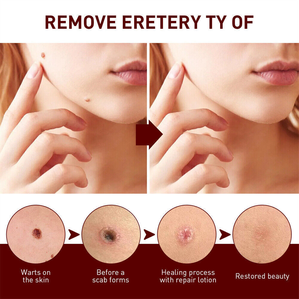 “FINAL SAL” Skin Tags & Moles Removal Quick Safe Remover Restore Skin 3ml US