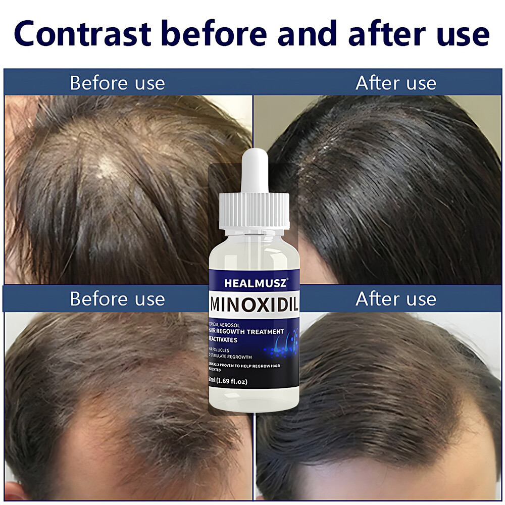 8 Bottles Minoxidil 5% Hair Regrowth Solution Extra Strength Men 8 Month Supply