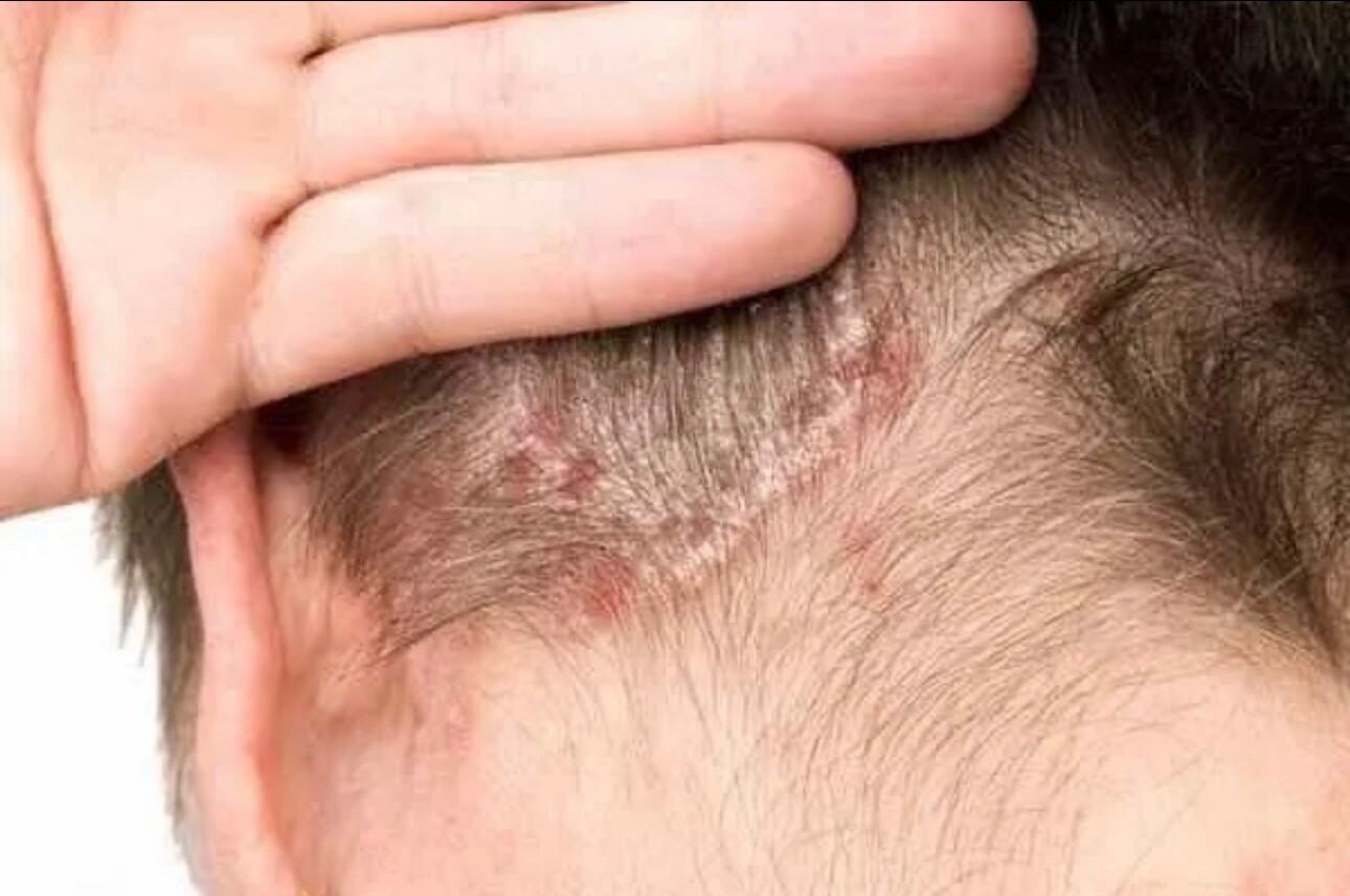 DMD- COMBO OF MEDI SKIN TREATMENT FOR PSORIASIS,ECZEMA.