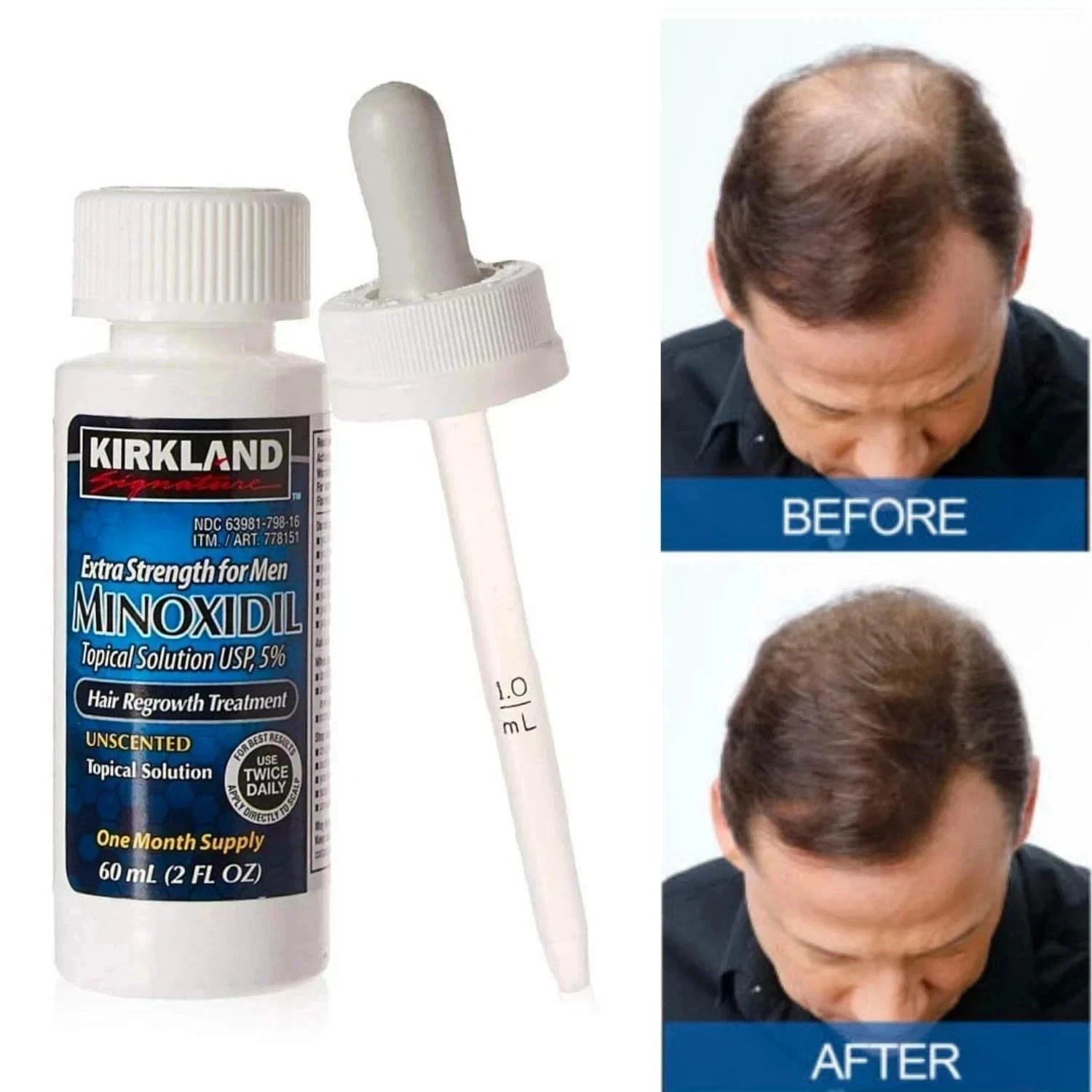 Kirkland Minoxidil 5% Extra Strength Men 6 Month Supply Hair Regrowth 2x