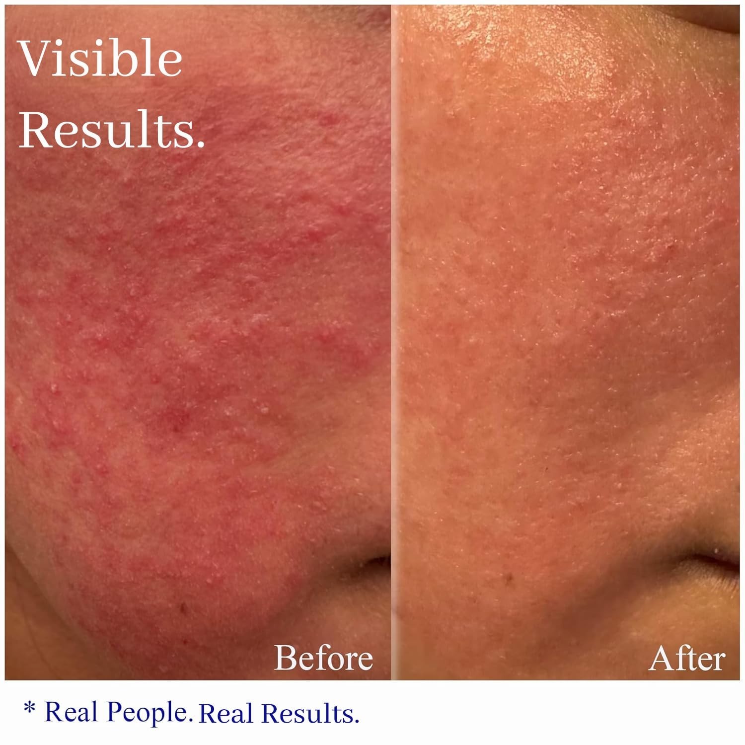 Dermatologist-Tested Rosacea Cream – Hydrating Relief for Facial Redness
