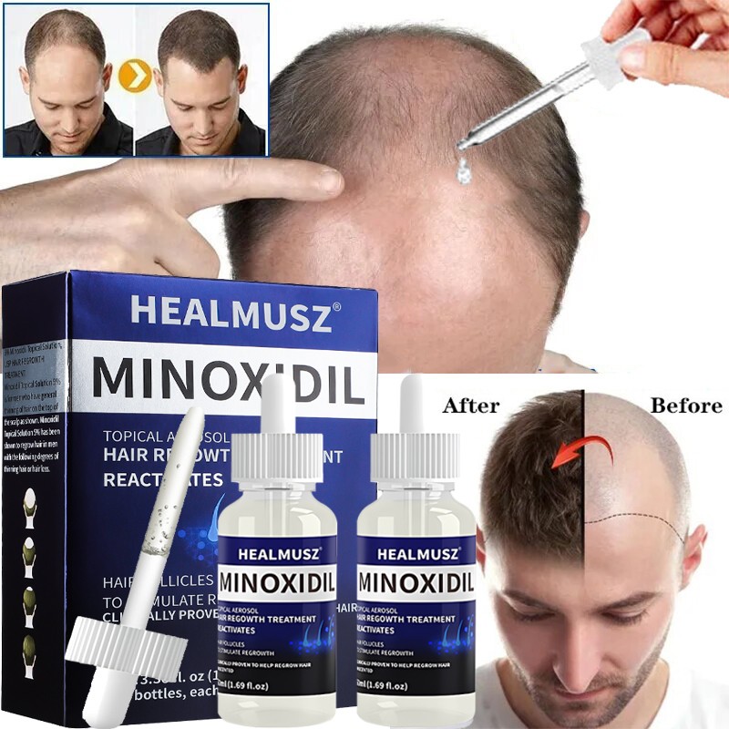 Minoxidil 5% Hair Regrowth Solution Extra Strength Men Women 2-10 Months Supply