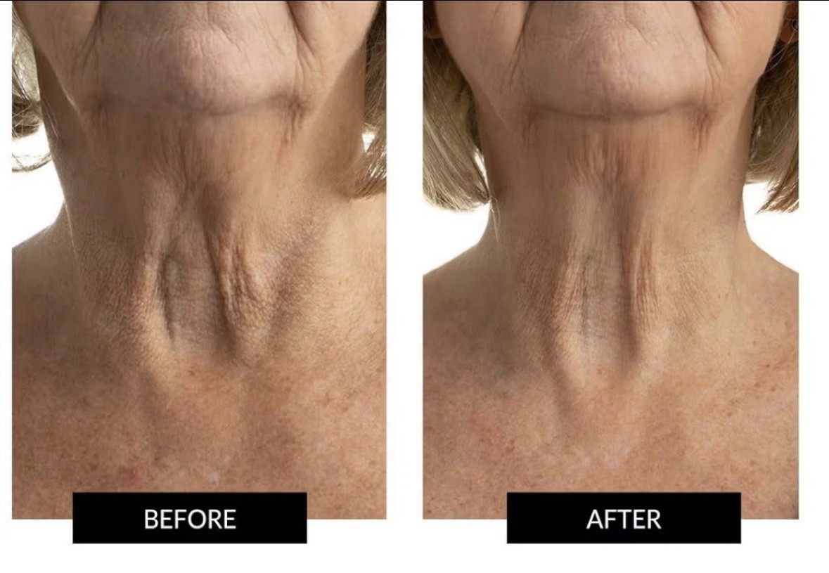 CurrentBody Skin LED Neck & Décolletage Fully Wearable Anti-Aging Mask New Open