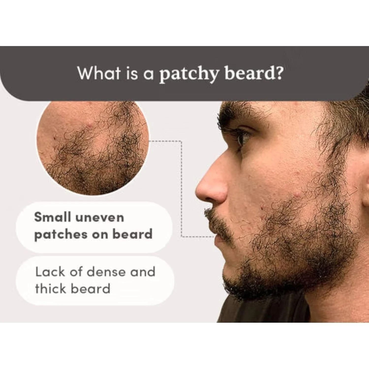 Beardmax Hair Growth Serum | Activates Beard Follicles | Solves Uneven & Patchy