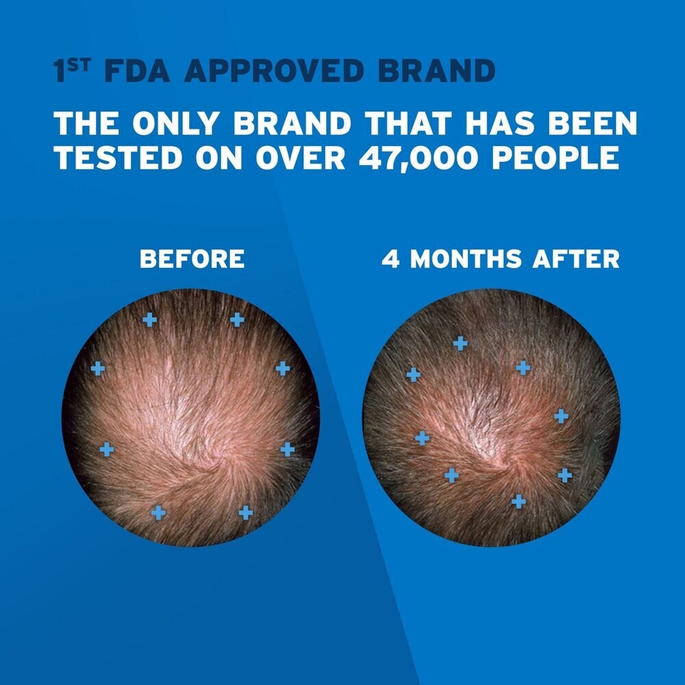 ✳️🔥 Rogaine Foam Hair Loss & Regrowth Treatment 5% Minoxidil – 1 – 4 Months🔥🔥