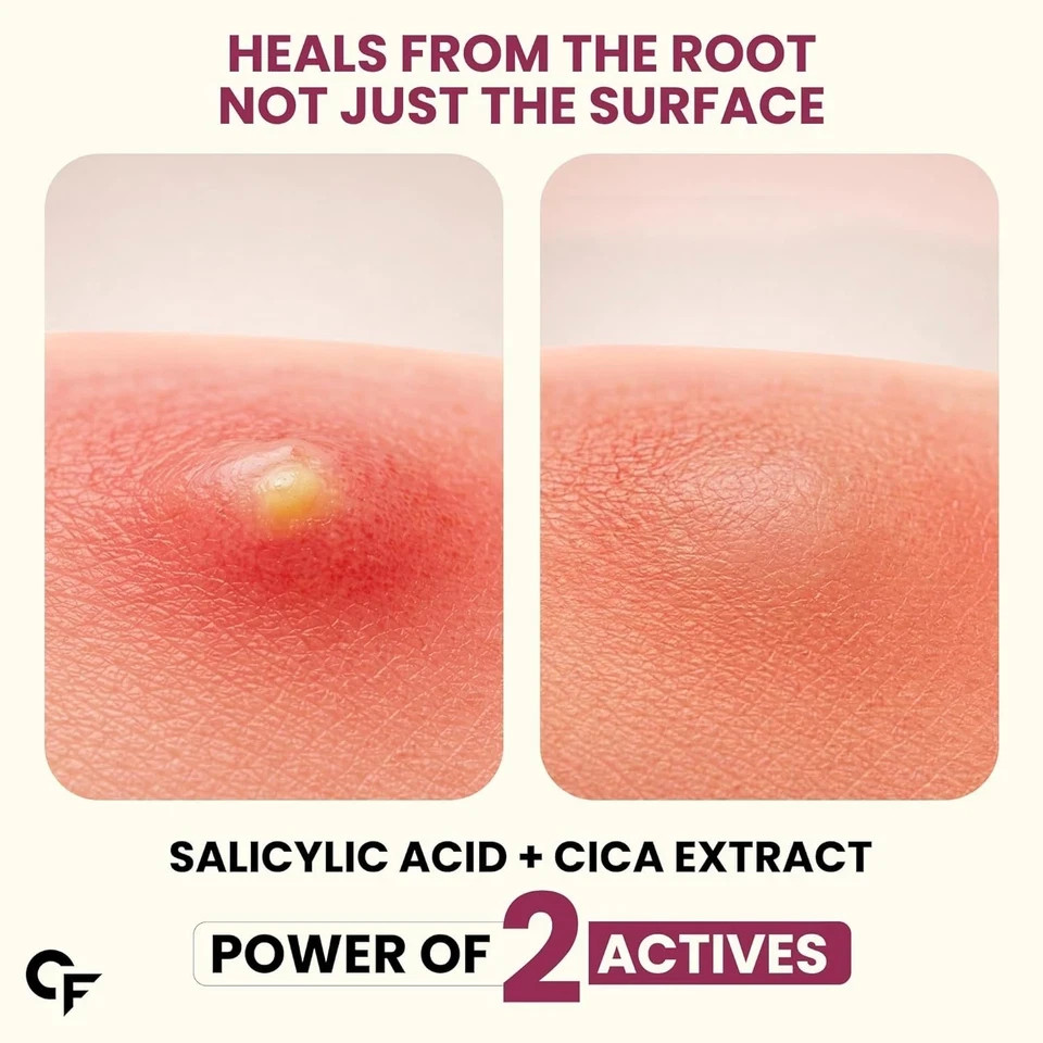 Carbamide Forte for Face Salicylic Acid & Cica 72 Hydrocolloid Pimple Patches