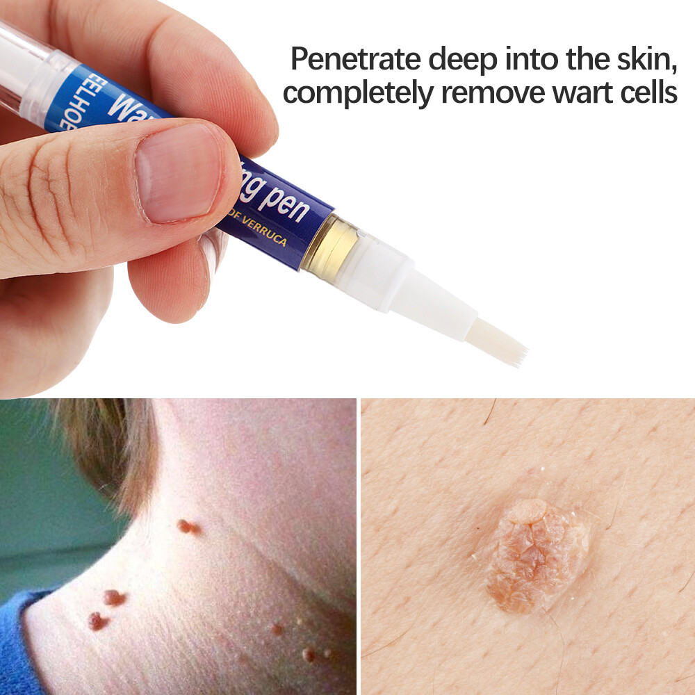 1 PACK Skin Tag Remover Pen Skin Tag Mole Wart Dark Spot Remover Painless & Safe