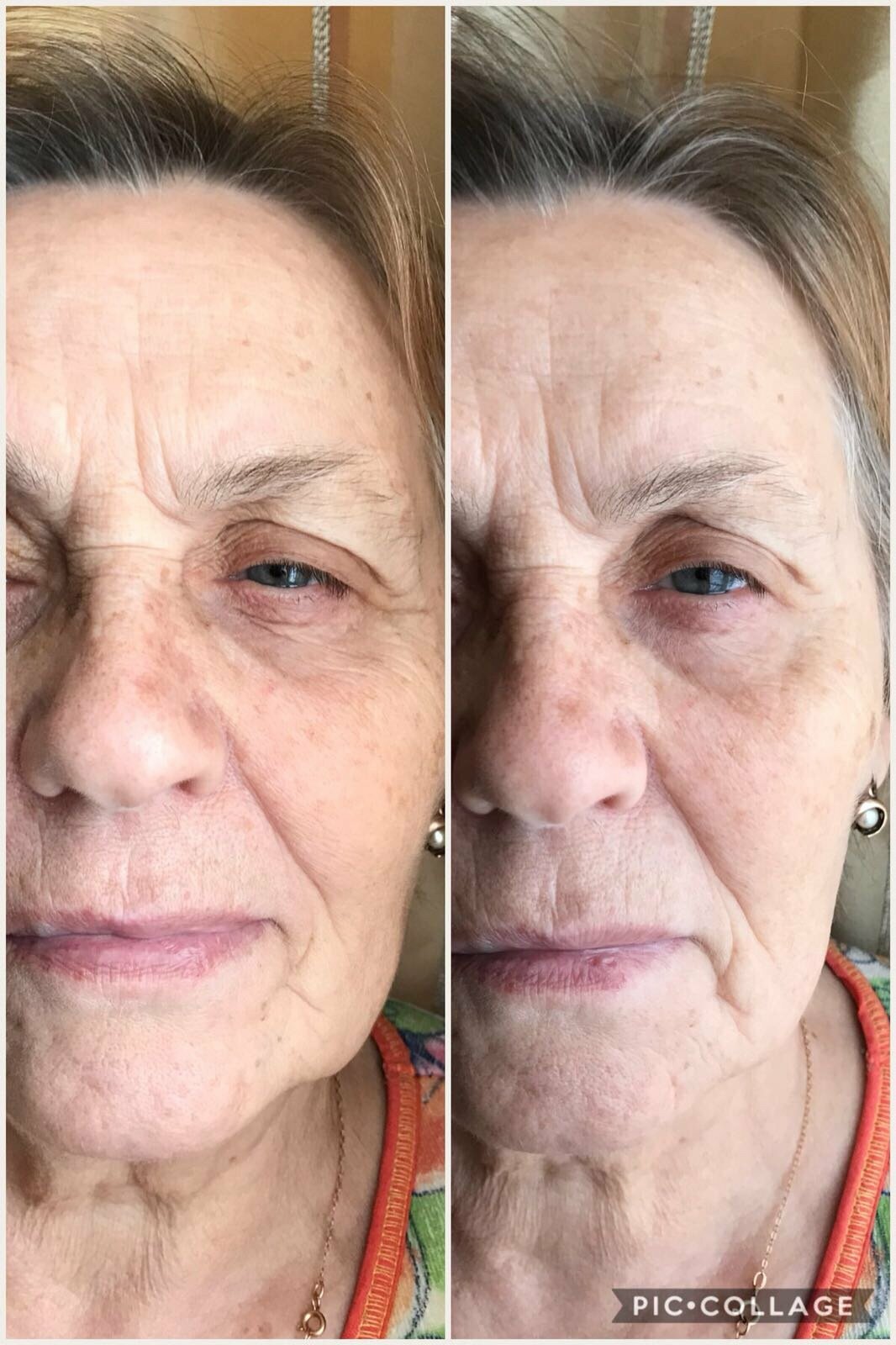 VITAYES Instant Ageback Anti-Aging Facelift Cream (15 ml Tube)