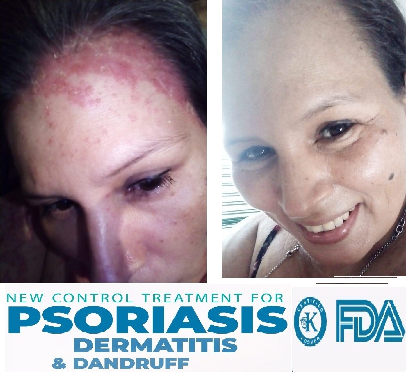 Dandruff Psoriasis Seborrheic Dermatitis 3 Pack Dermabon natural