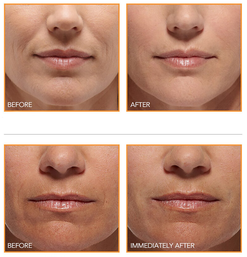 100% Pure Organic HYALURONIC ACID SERUM AntiAging Hydrating Wrinkle Filler Cream