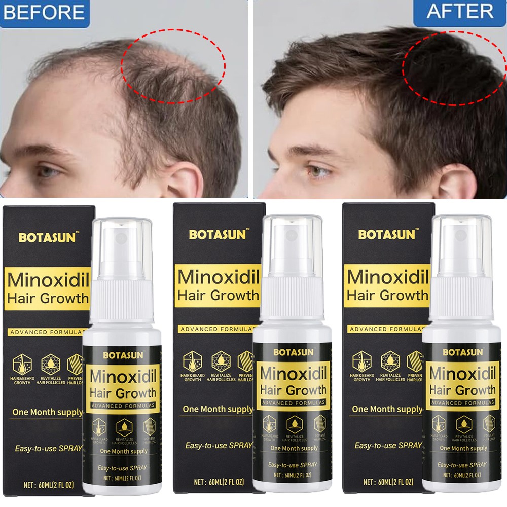 3 Pack 5% Minoxidil Hair Growth Serum Spray for Men Hair Regrowth 3 Month Supply