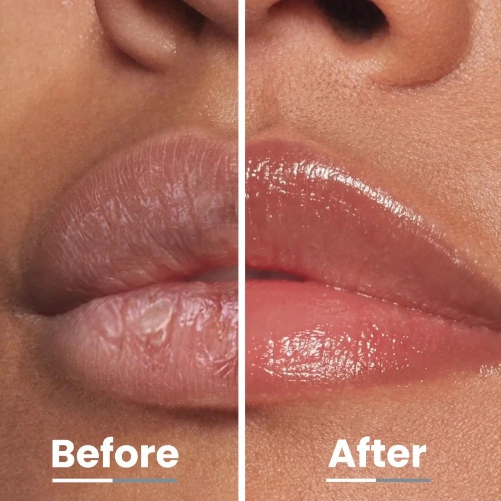 Hyphen 2% Kojic Acid Spf 30 Lip Balm With Vitamin C,1% Vit E,Brightens Pigmented