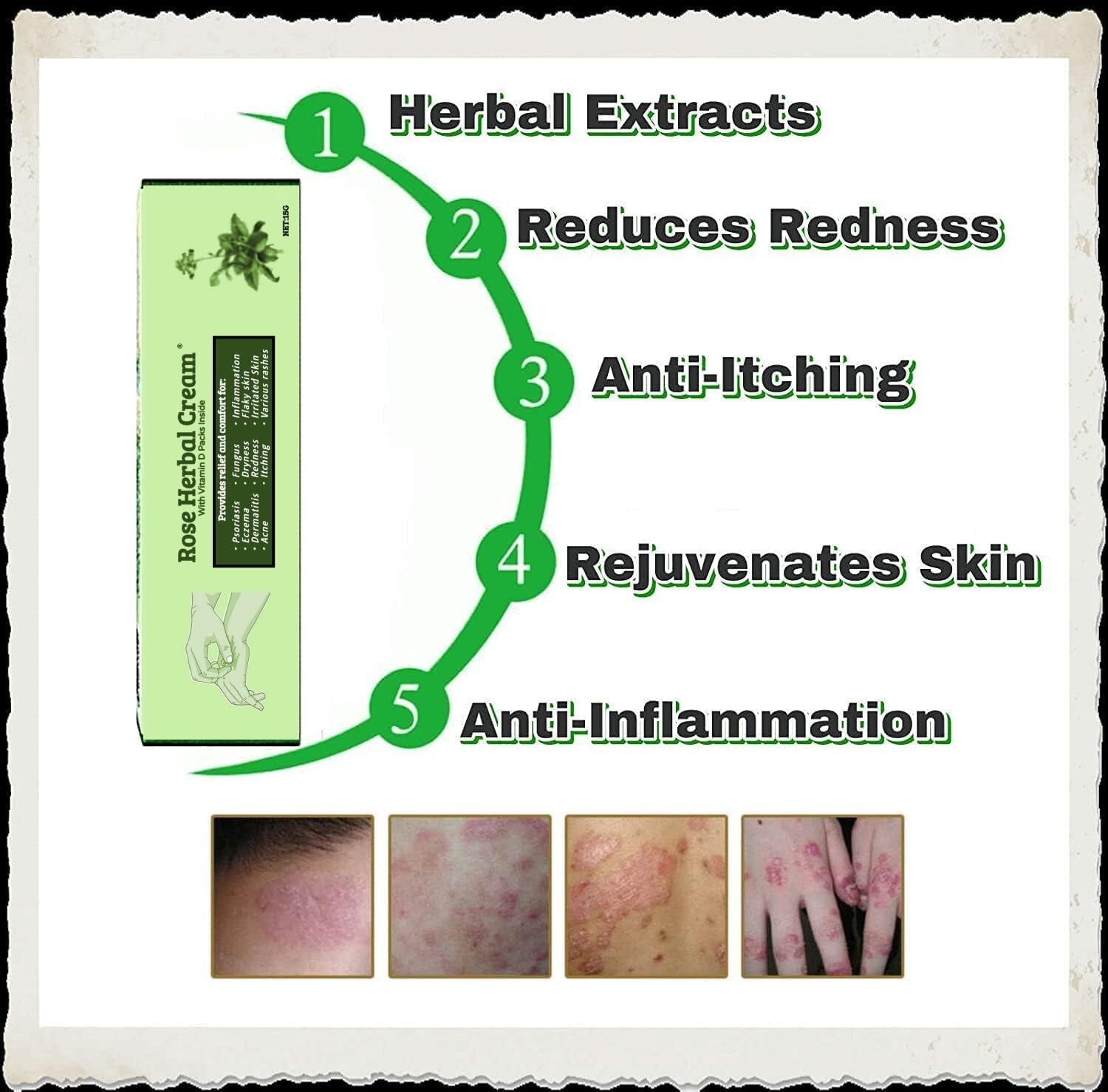 Eczema Psoriasis CREAM Ointment Inflammation Natural Anti Itching Dermatitis