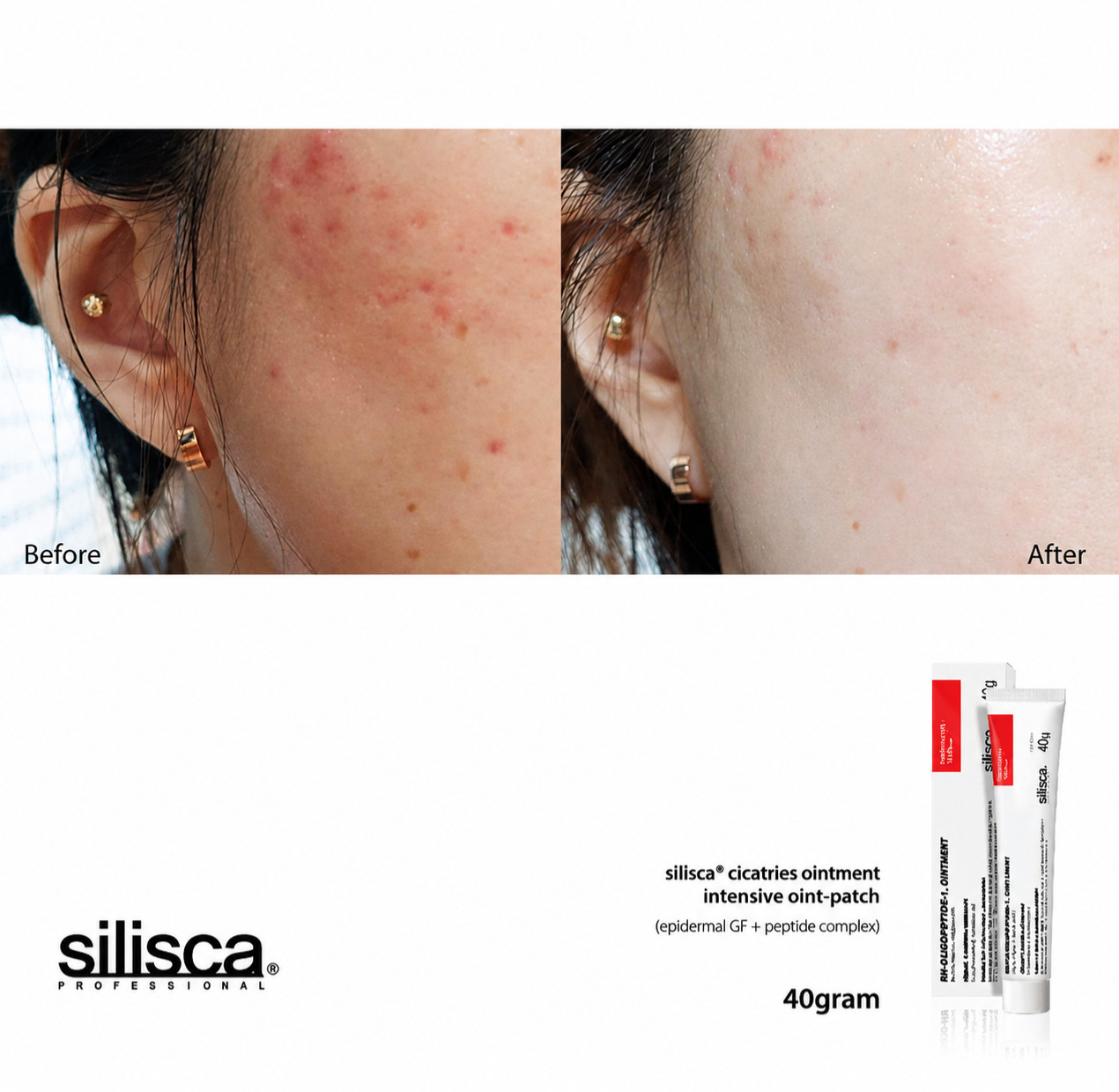 Silisca Cicatries Ointment 40g Intensive Skin Recovery Cream+FREE SAMPLES